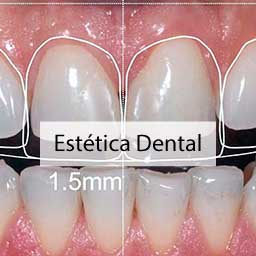 Estética Dental