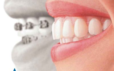Invisalign