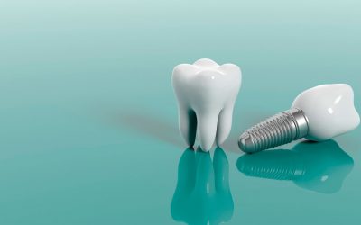 Implantes dentales