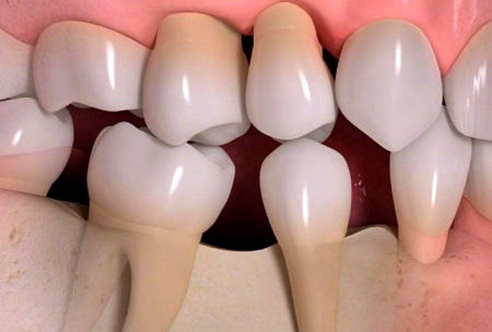 ¿Qué sucede cuando falta una pieza dental?
