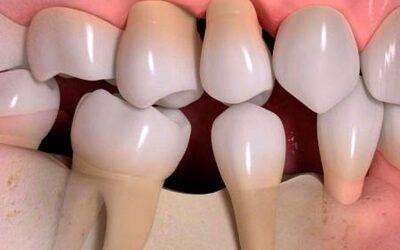 ¿Qué sucede cuando falta una pieza dental?