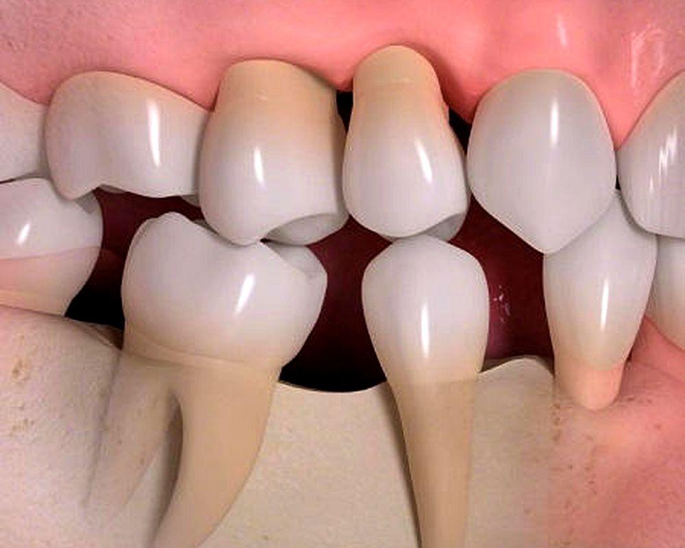 Movimiento de piezas dentales