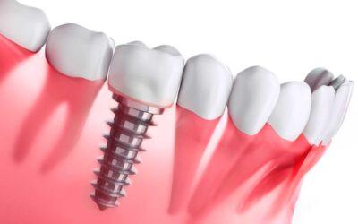 Causas de la pérdida de hueso dental y cómo detenerlo