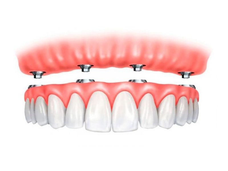 Movimiento de piezas dentales