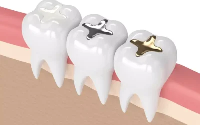 Tipos de empastes dentales