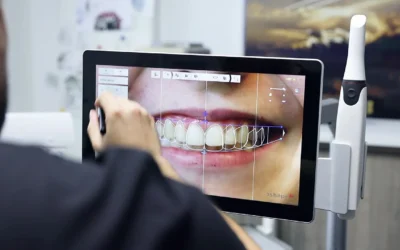 ¿Qué es el diseño digital de sonrisa?