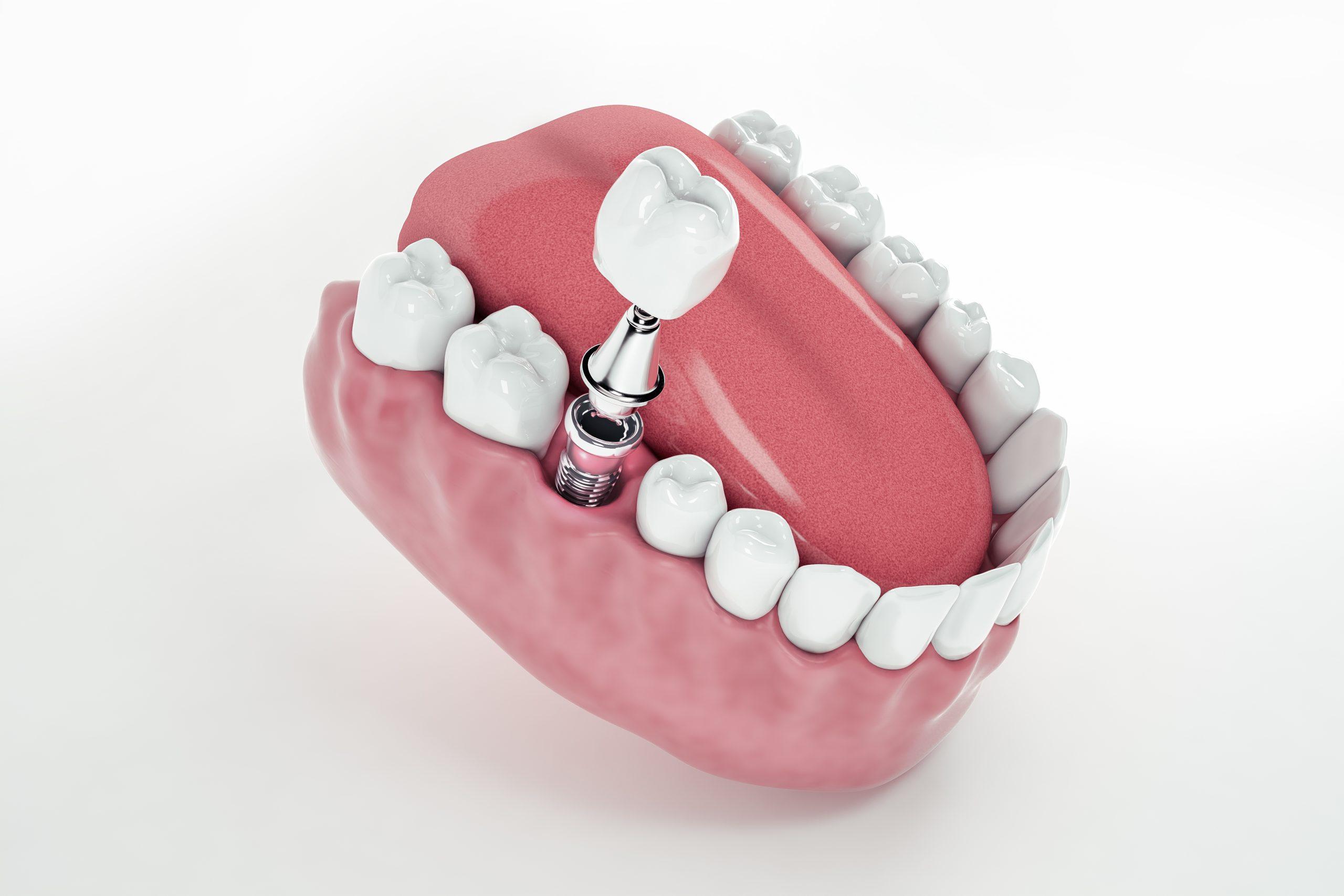 Implante dental